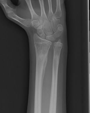 Distal Radius Growth Arrest